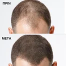Toppik Ίνες Κάλυψης Αραίωσης Μαλλιών με Κερατίνη Regular Dark Brown 12gr πριν-μετά