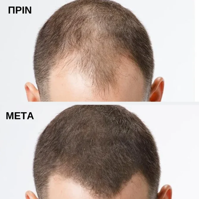Toppik Ίνες Κάλυψης Αραίωσης Μαλλιών με Κερατίνη Regular Dark Brown 12gr πριν-μετά